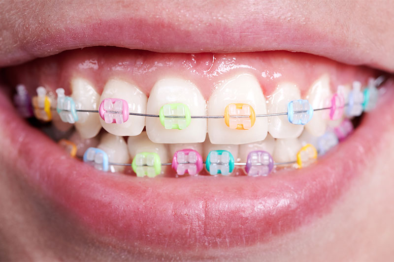 Metal Braces with Fun Colors in West Orange