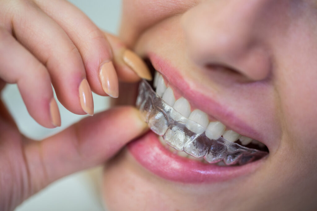 Removable Retainers Newark NJ