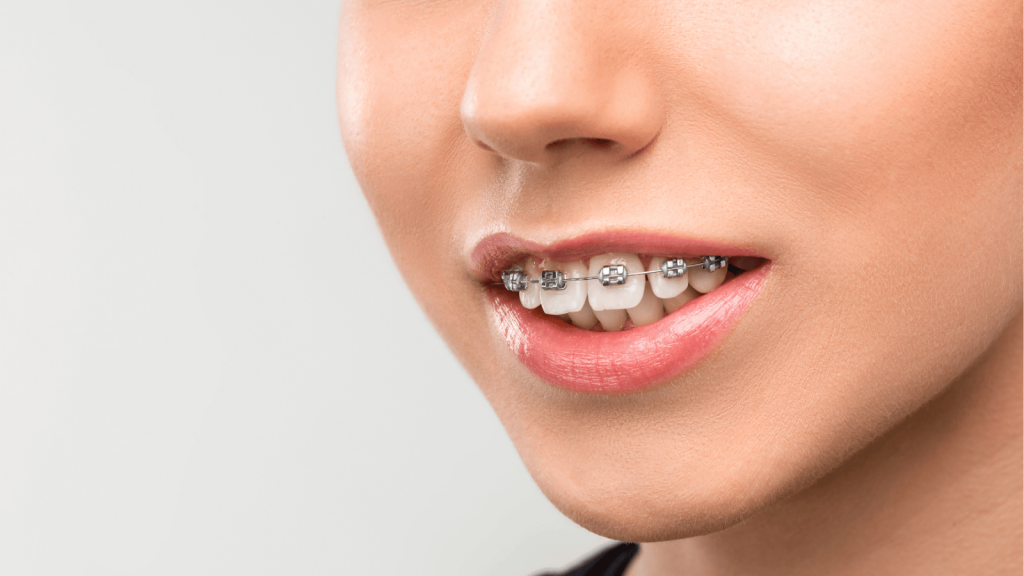 Overbite Treatment in West Orange NJ