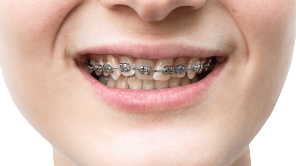 Underbite Treatment in West Orange NJ