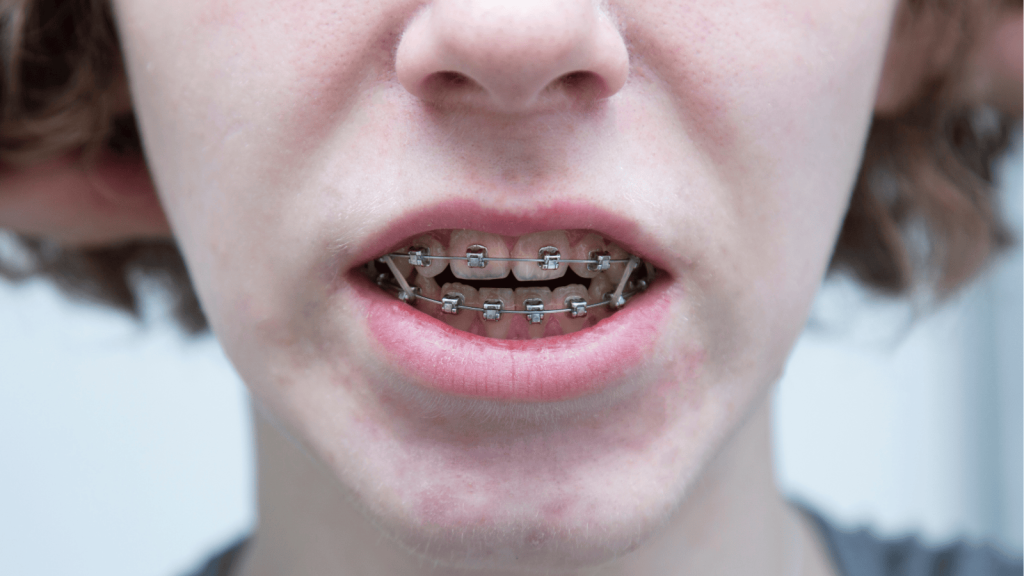 Open Bite Treatment in West Orange, NJ
